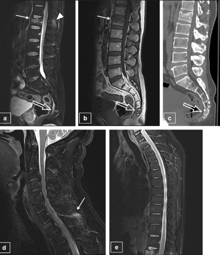 MRI of the Sacrum and Coccyx (Tailbone) at … — image 2