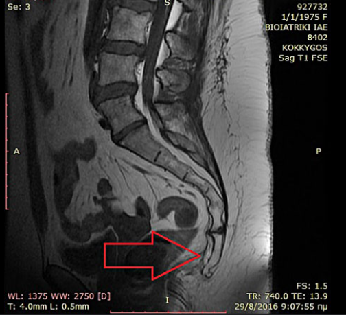 MRI of the Sacrum and Coccyx (Tailbone) at … — image 3
