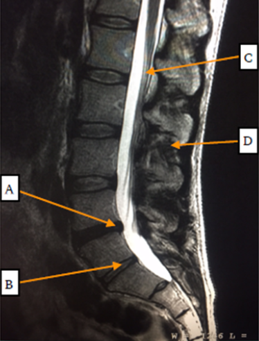 MRI of the Sacrum and Coccyx (Tailbone) at … — image 4