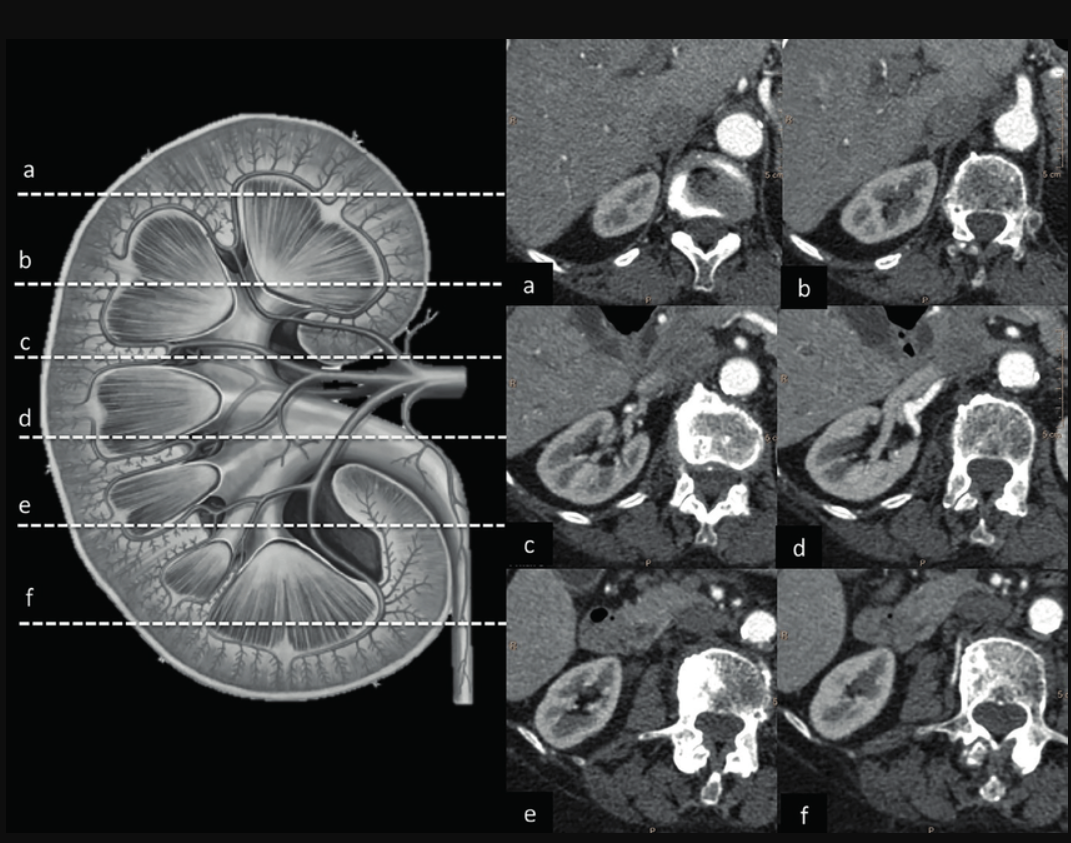 MRI of the Kidneys — What It Shows, … — image 1