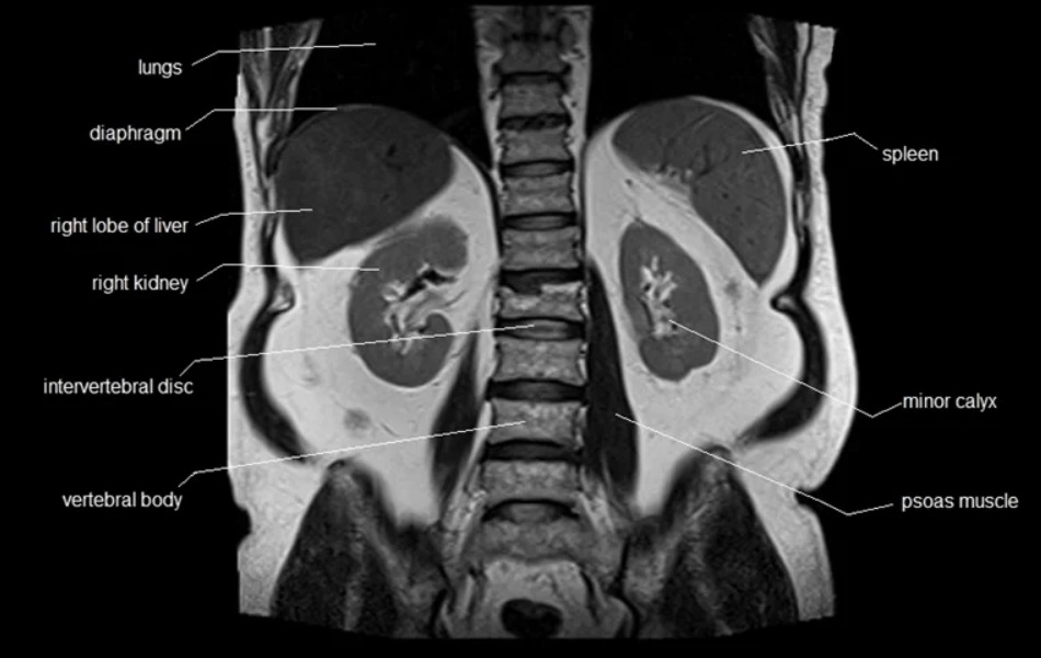 MRI of the Kidneys — What It Shows, … — image 2