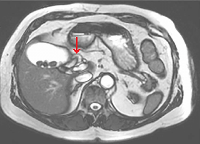 MRI of the Gallbladder: A Comprehensive Guide