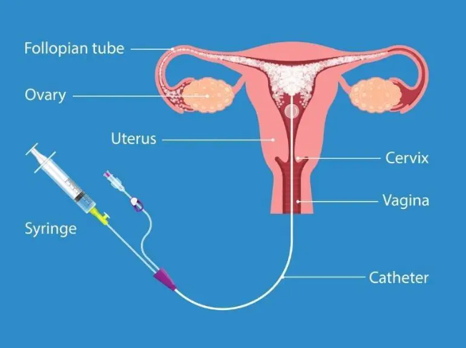 Get done Hysterosalpingography (HSG) at Just Rs. 4000/-