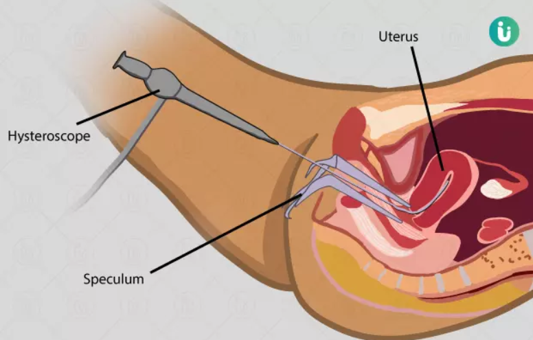 Get done Hysterosalpingography (HSG) at Just Rs. 4000/- — image 2