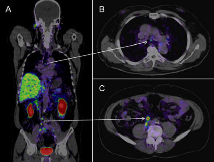 PSMA PET CT Scan — Everything You Need … — image 3